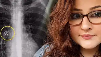 Genç Kadının Akciğerine Saplanan Septum Piercingi Bronkoskopi ile Çıkarıldı
